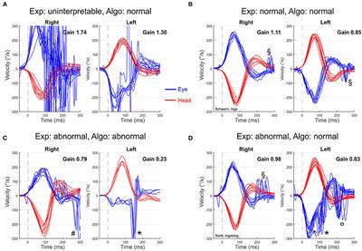 A Simple Gain-Based Evaluation of the Video Head Impulse Test Reliably Detects Normal Vestibulo-Ocular Reflex Indicative of Stroke in Patients With Acute Vestibular Syndrome